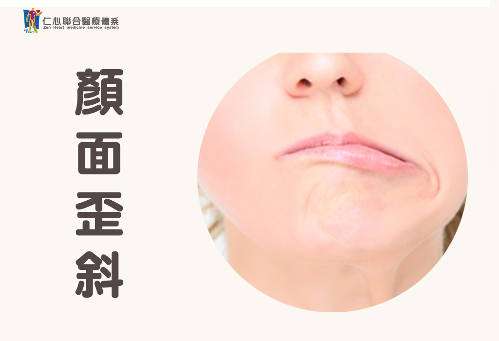 颜面神经麻痹
