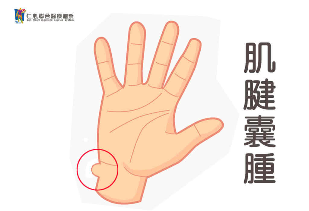 肌腱囊肿